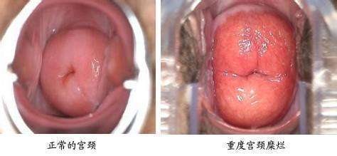 宫颈糜烂会不会影响怀孕
