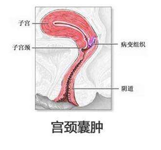 杭州哪治疗宫颈囊肿好
