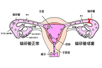 女性不孕和输卵管堵塞的关系
