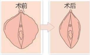 杭州小阴唇修复术哪家好呢
