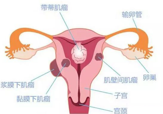 子宫肌瘤的由来因素有哪些呢