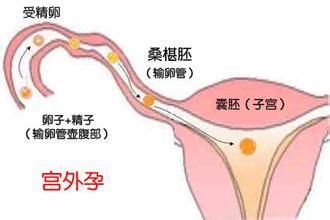 导致宫外孕的原因有什么
