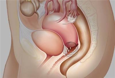 杭州女性应该如何预防宫颈糜烂