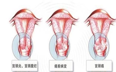 杭州宫颈糜烂的症状有哪些